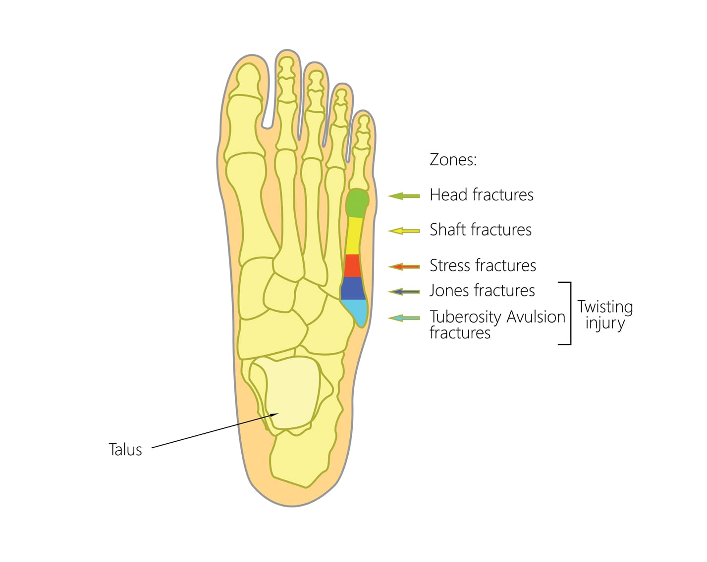 Jones kırığı ve ayak bölgesindeki kemiklerin gösterildiği bir görsel.