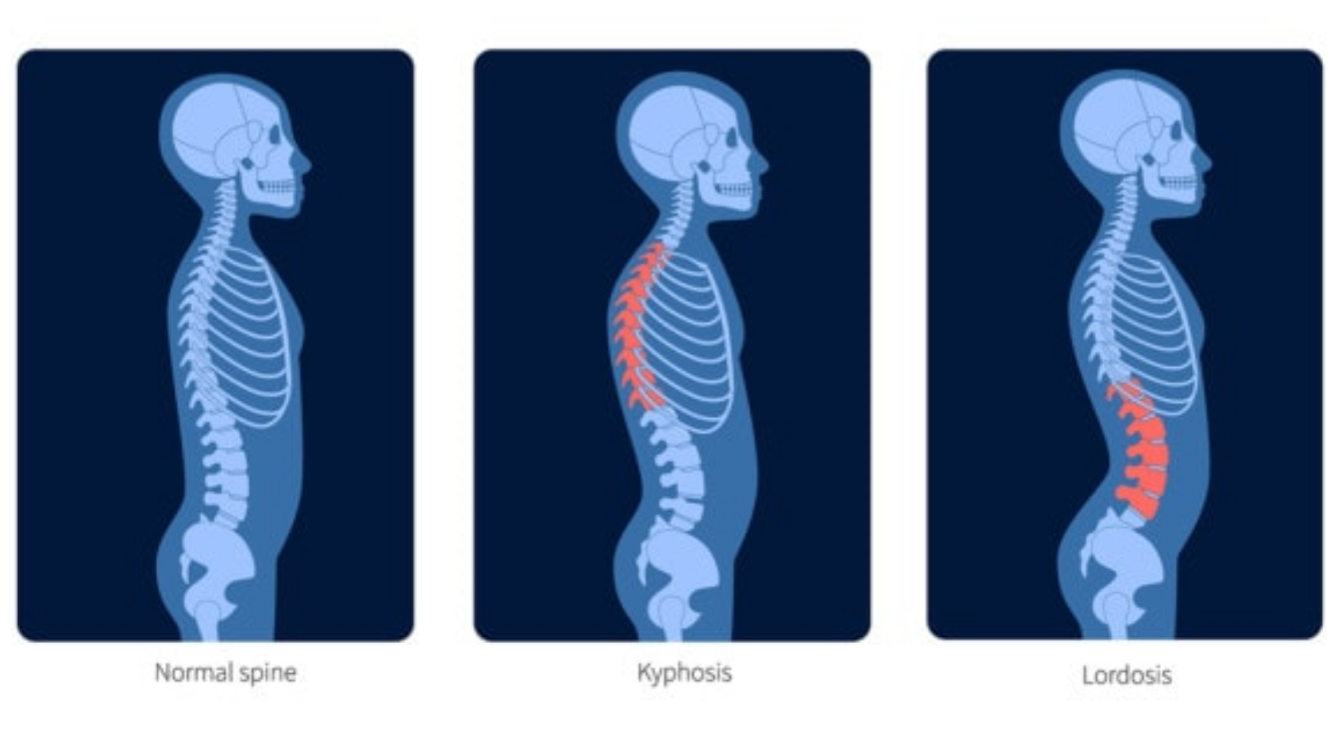 Normal spine, kyphosis ve lordosis hakkında bir görsel.